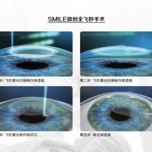 重庆高考后近视手术全解析：全飞秒、半飞秒、全激光、ICL晶体植入如何选择